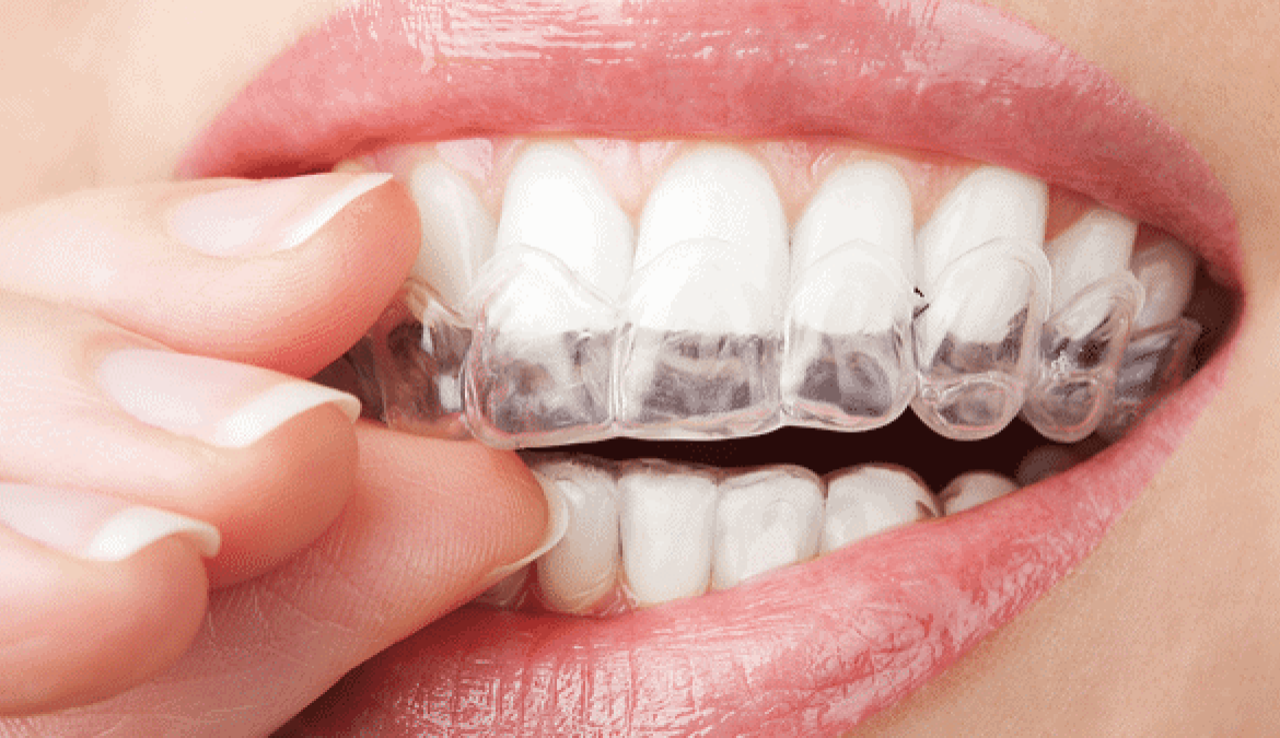 The Transformative Effects of Invisalign Treatments in Leicester