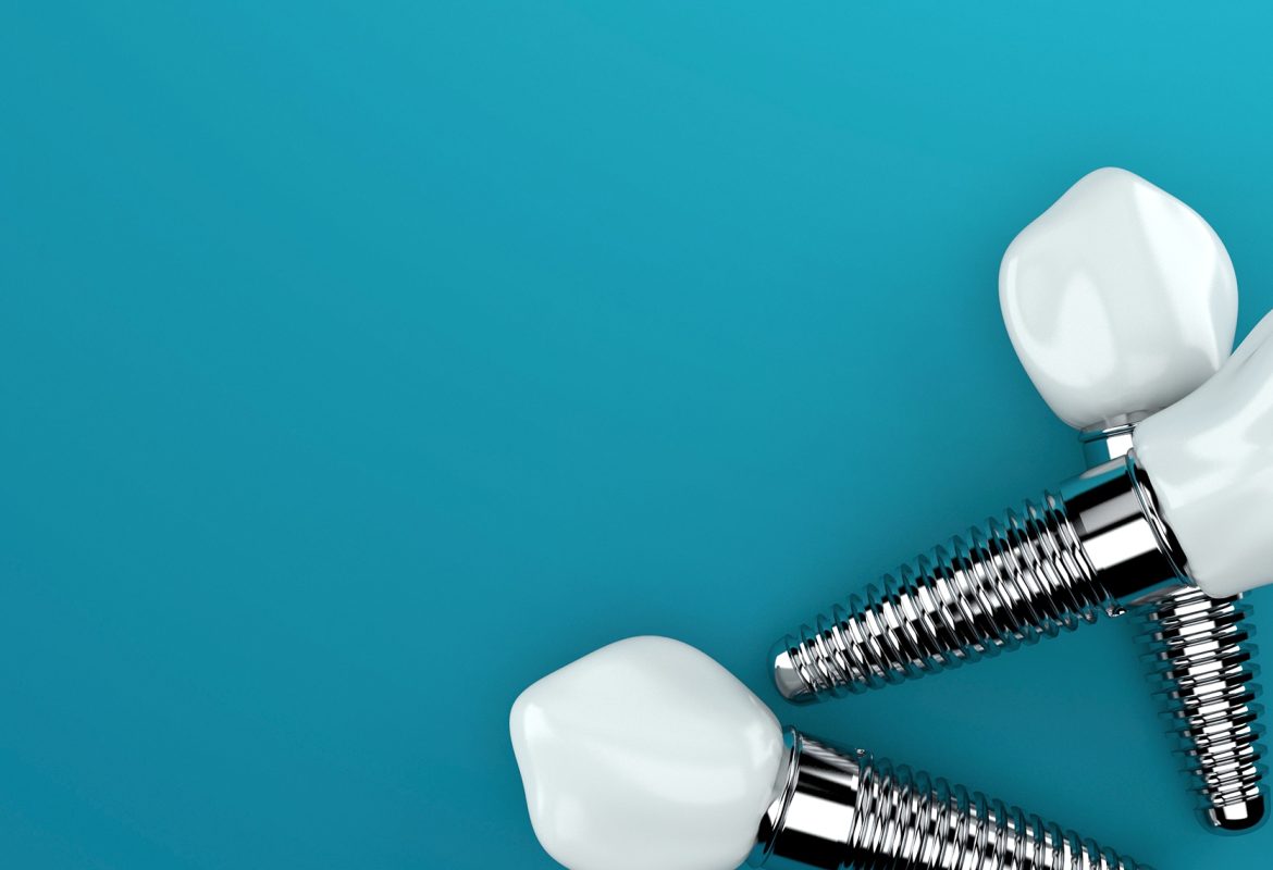 Exploring the Impact of Dental Implants on Oral Health and Wellbeing